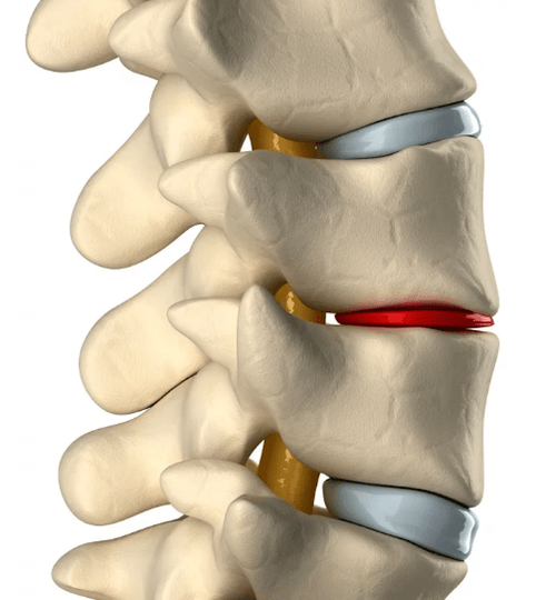 Krūškurvja mugurkaula osteohondroze