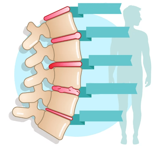 Krūškurvja osteohondrozes slimības pakāpe