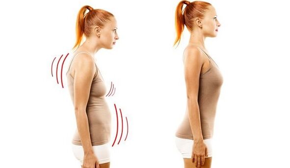 taisna mugura un slikta stāja ar dzemdes kakla osteohondrozi